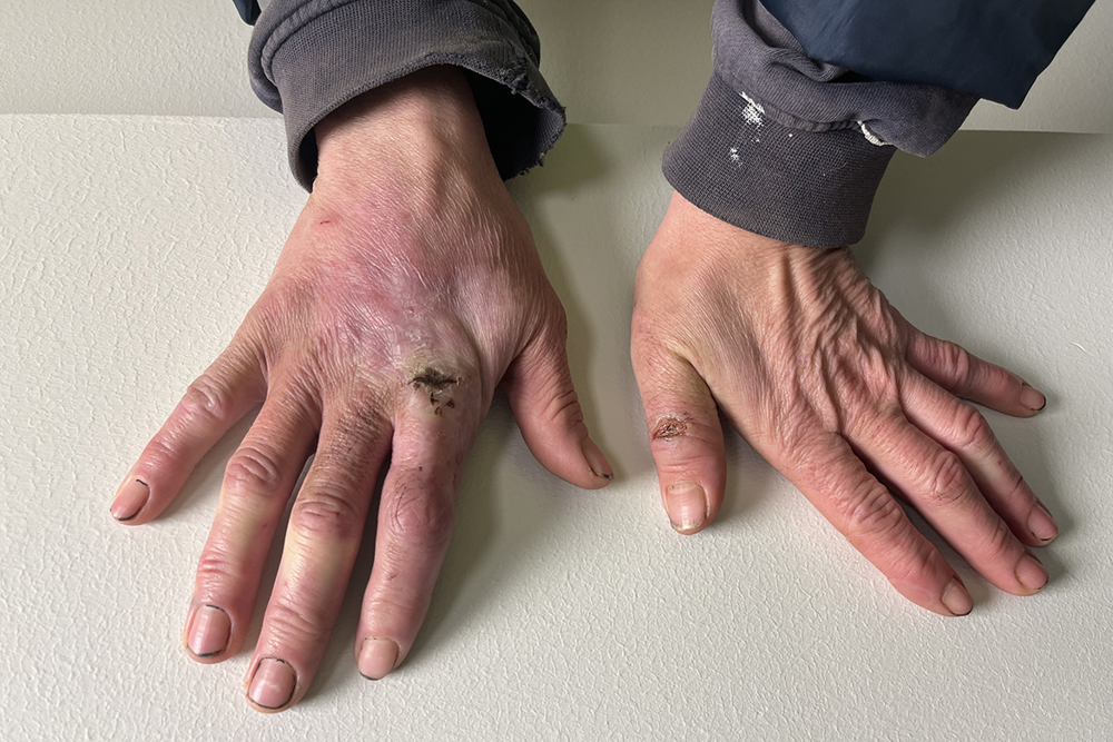 Bild från förundersökning som visar målsägandes händer efter att ha arbetet utan skyddsutrustning.